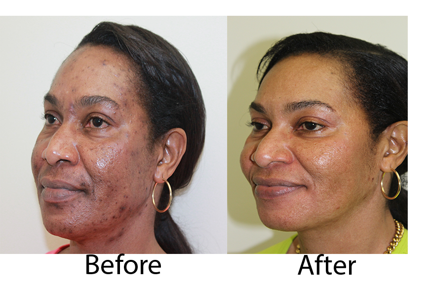 Laser Therapy Pre-treatment